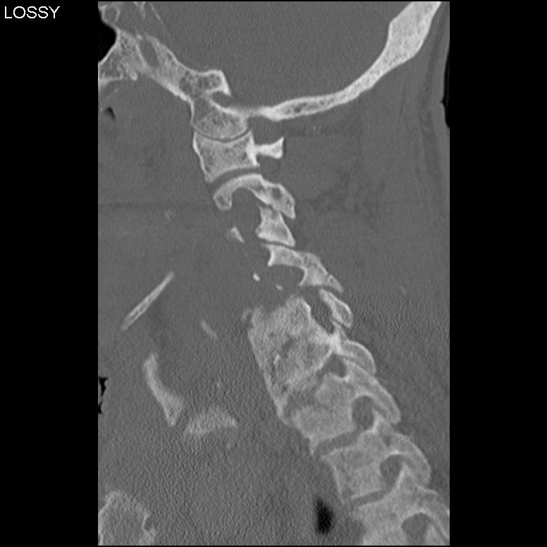 Cervical Osteomyelitis CT